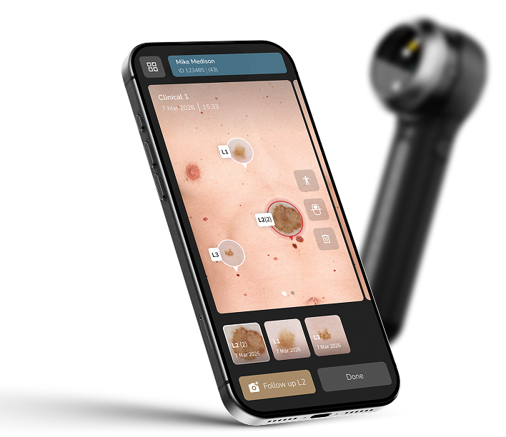 Digital dermoscopy imaging device and smartphone interface (reference image)